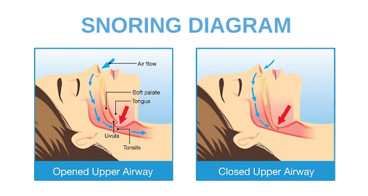 open mouth sleeping symptoms